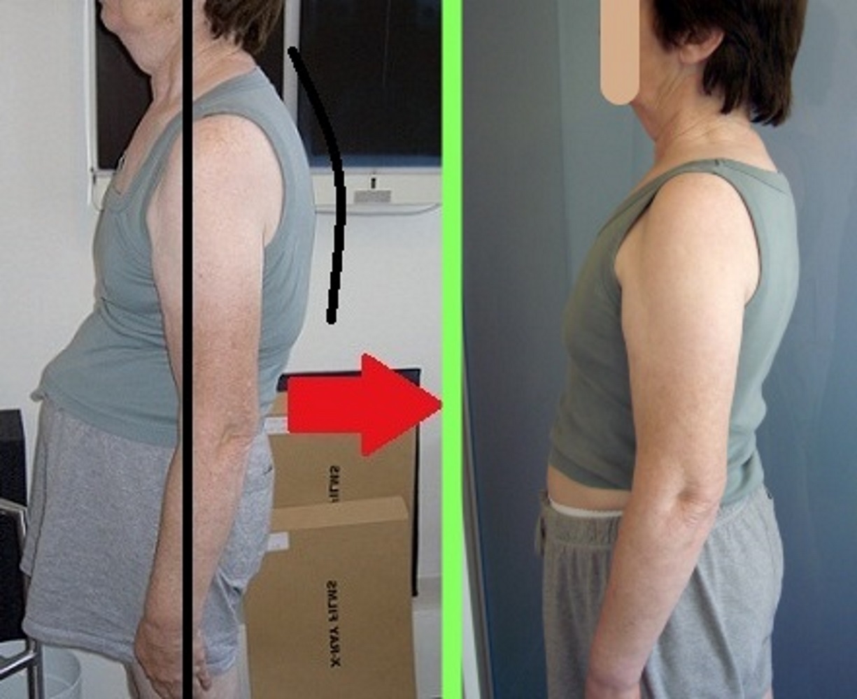 My Patients’ Incredible Posture Results